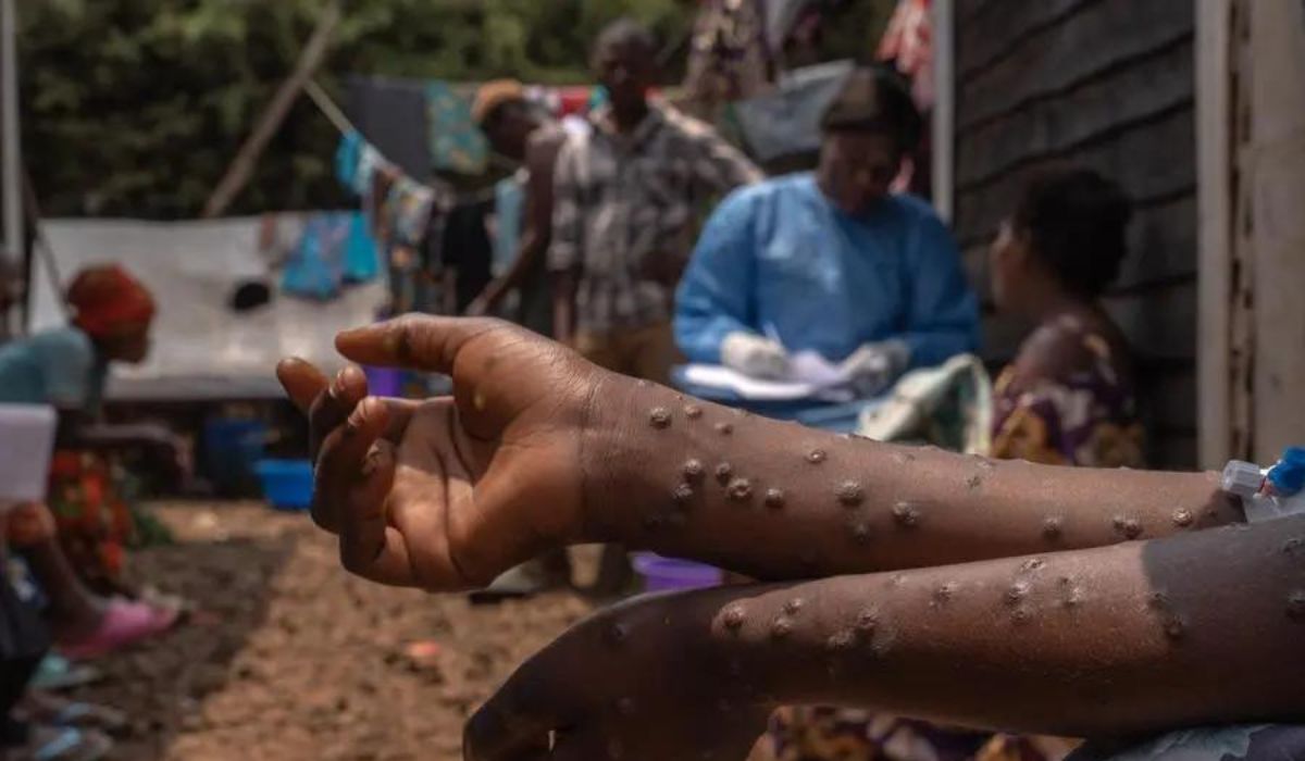 Africa Reports Nearly 4,000 New Mpox Cases as Vaccine Wait Continues